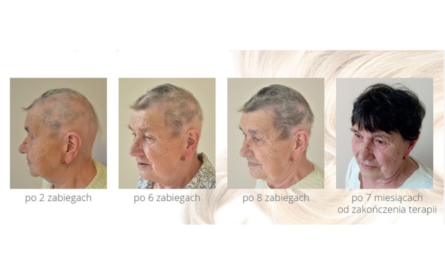 Zapomnij o wypadaniu wlosow