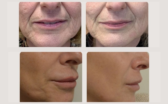 Sekret Mlodosci Rewolucyjny Laser Wolumetryczny