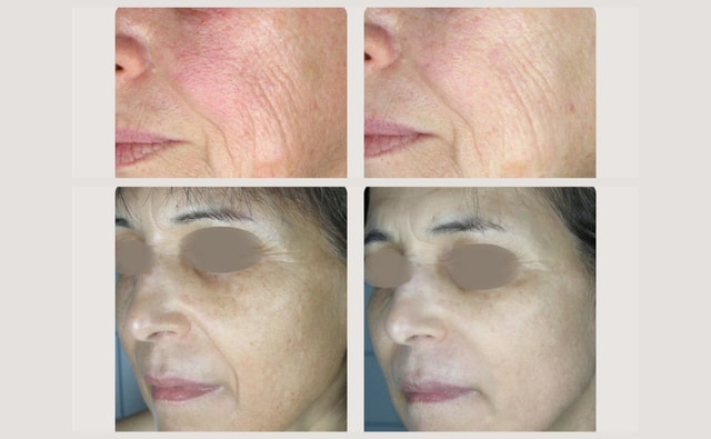 Sekret Mlodosci Rewolucyjny Laser Wolumetryczny